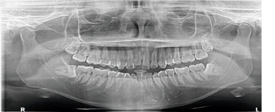 スタッフBの歯のレントゲン画像