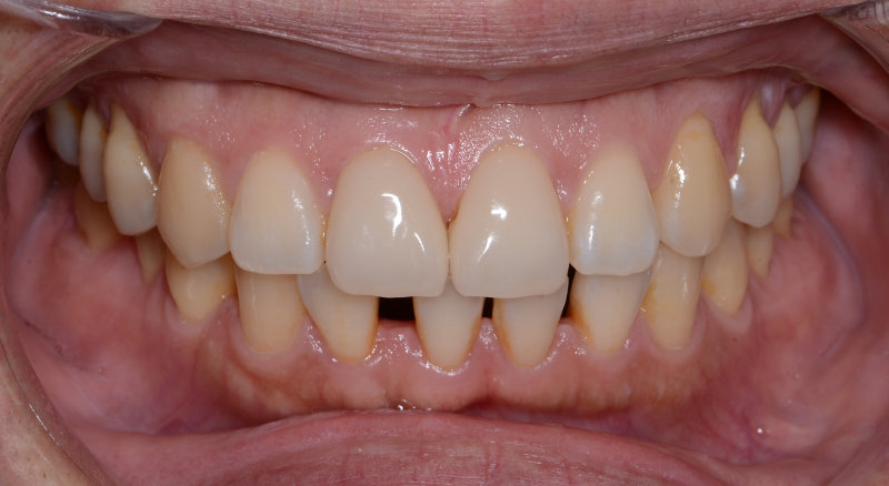 スタッフCの歯の正面の画像