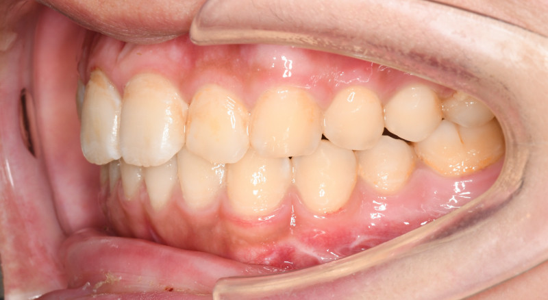 外科手術3ヶ月後の口腔内の画像