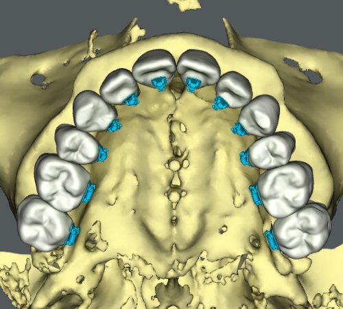 治療後の歯の位置を示した3Dモデルの画像