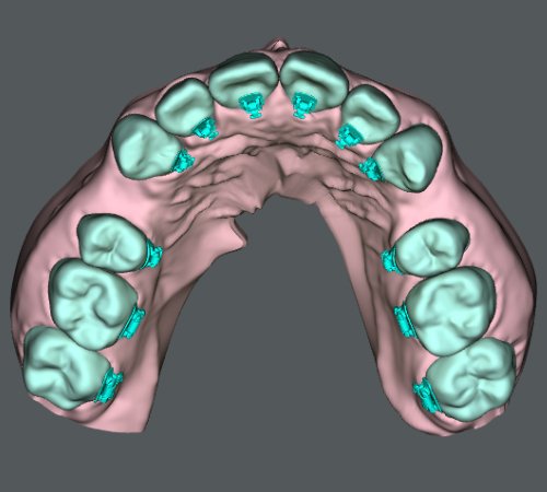 歯肉と矯正装置がモデル化されている画像