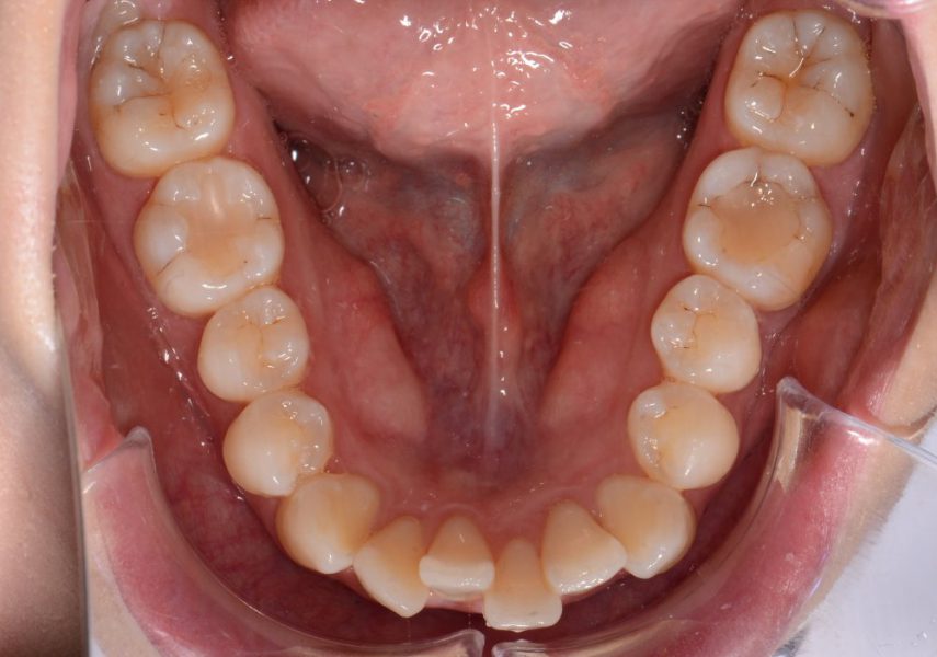 下顎の歯並びの画像