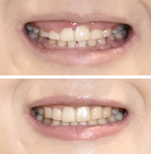 ガミースマイル治療のイメージ画像