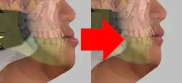 サージェリーファーストのビフォーアフターの実際例の画像